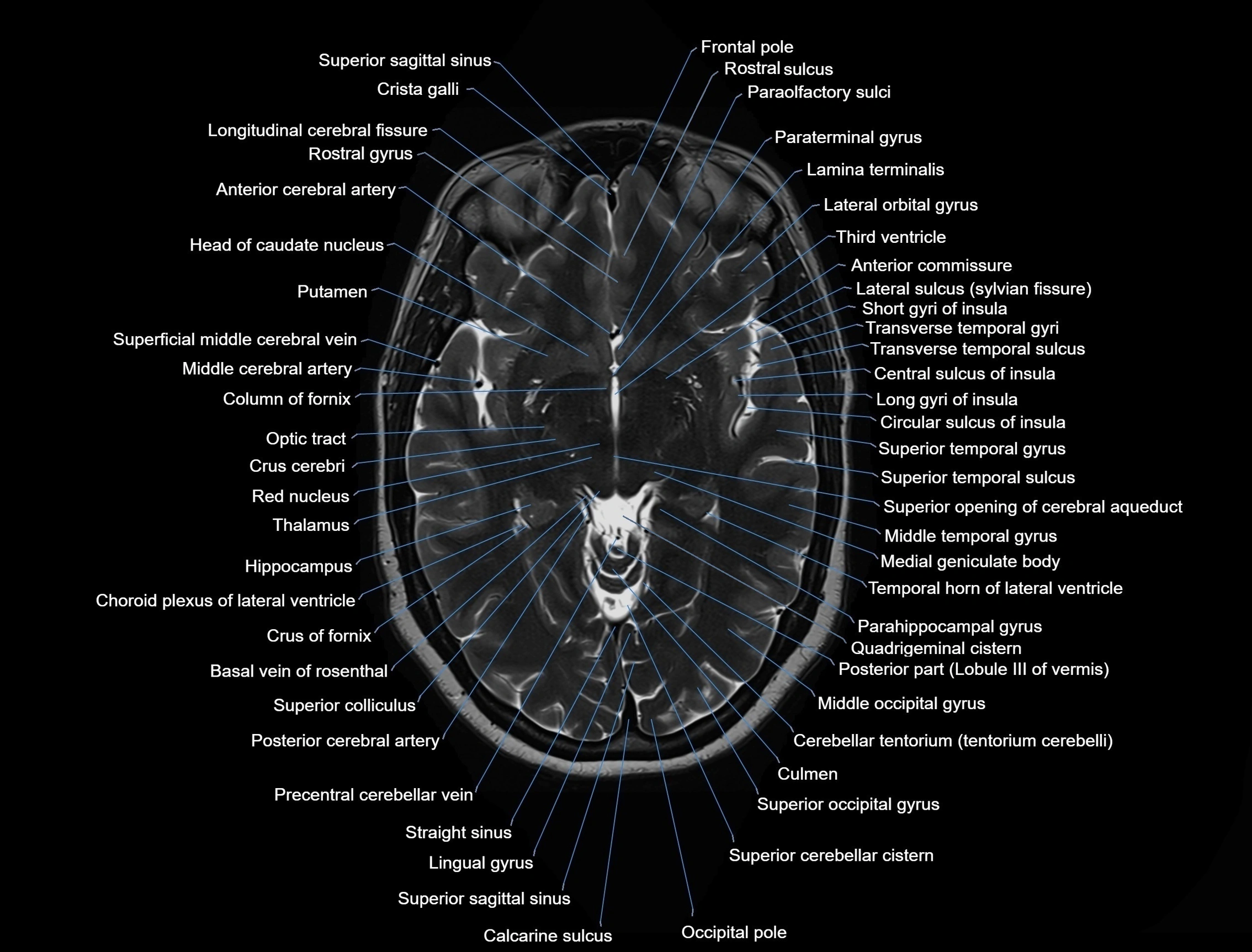 MRI Brain axial cross sectional radiology anatomy 3T image  -img-00001-00026.webp